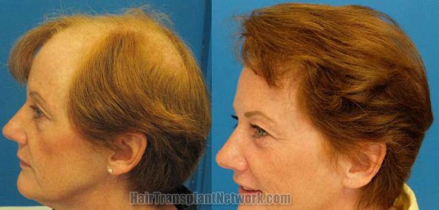 Hair restoration procedure before and after pictures