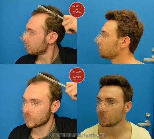 Hair transplantation surgery before and after photos