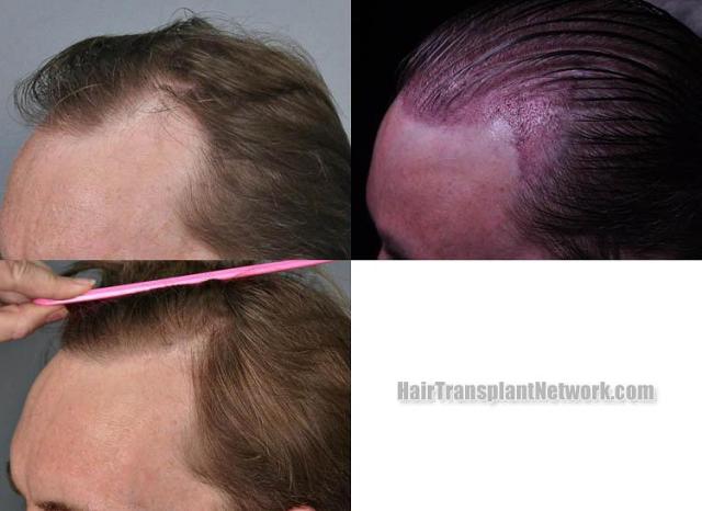 Hair restoration procedure before and after pictures