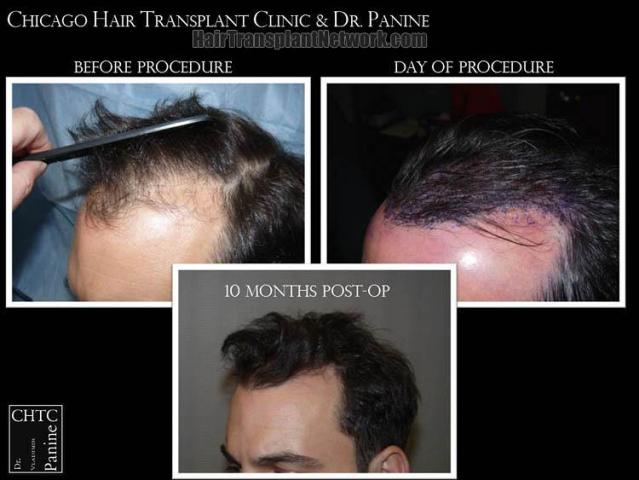 Hair transplantation surgery before and after photos