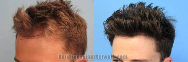 Hair transplantation surgery before and after pictures