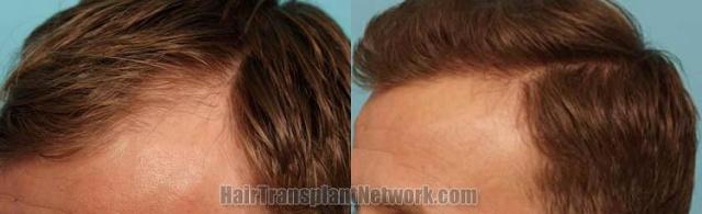 Hair transplantation surgery before and after pictures