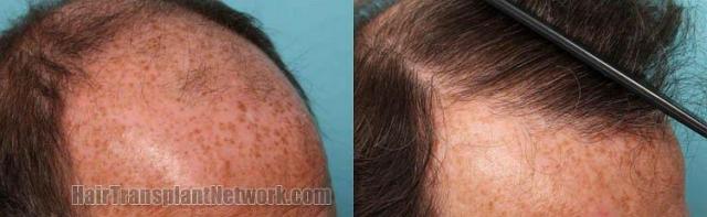 Right side before and after hair restoration photos