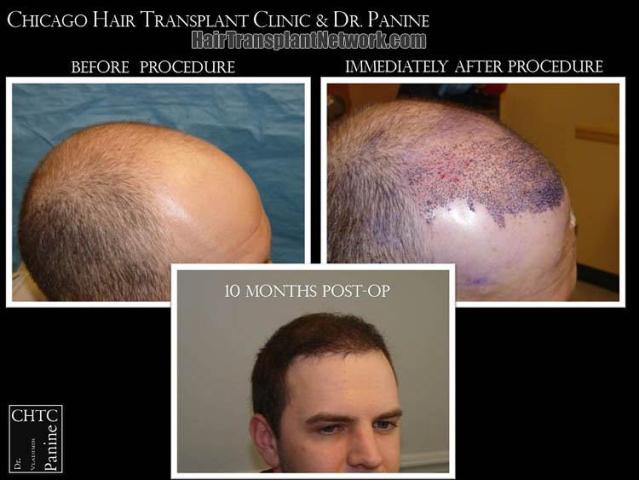 Hair transplantation surgery before and after photos