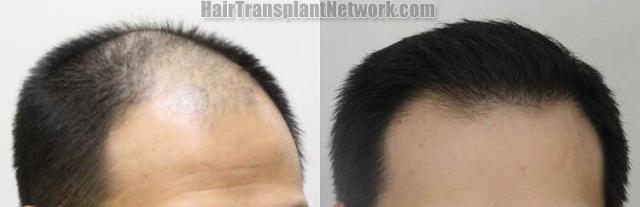 Hair transplantation surgery before and after images