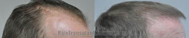 Hair restoration procedure before and after results