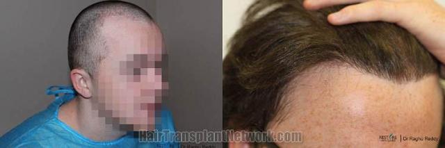 Hair transplantation surgery before and after images