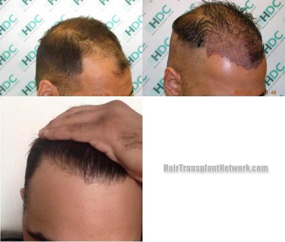 Hair transplantation surgery before and after pictures