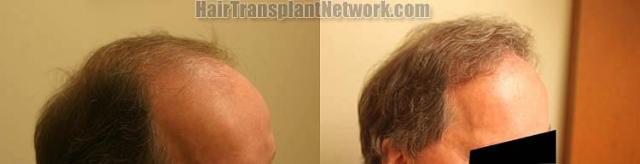 Hair transplantation surgery before and after images