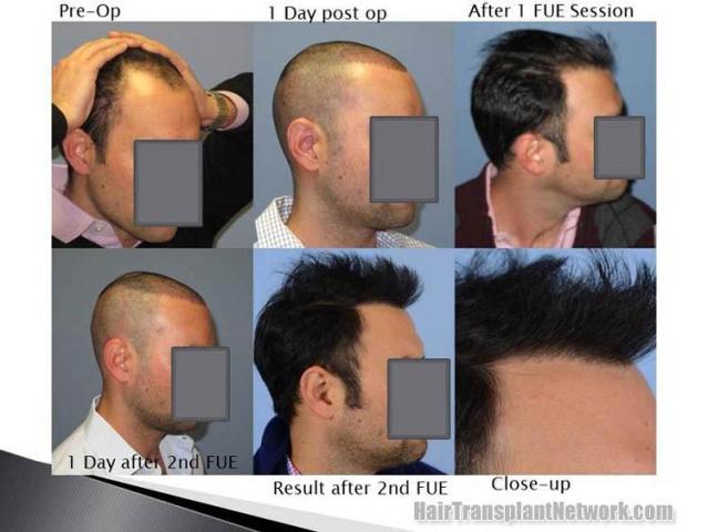 Hair transplantation surgery before and after images