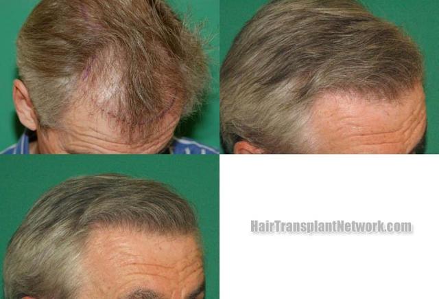 Hair transplantation surgery before and after photos