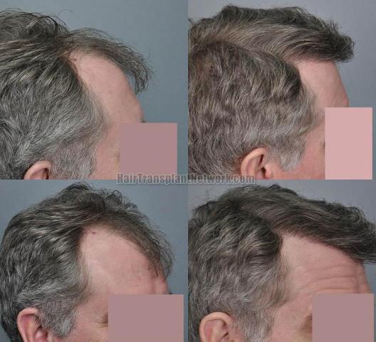 Hair transplantation surgery before and after pictures