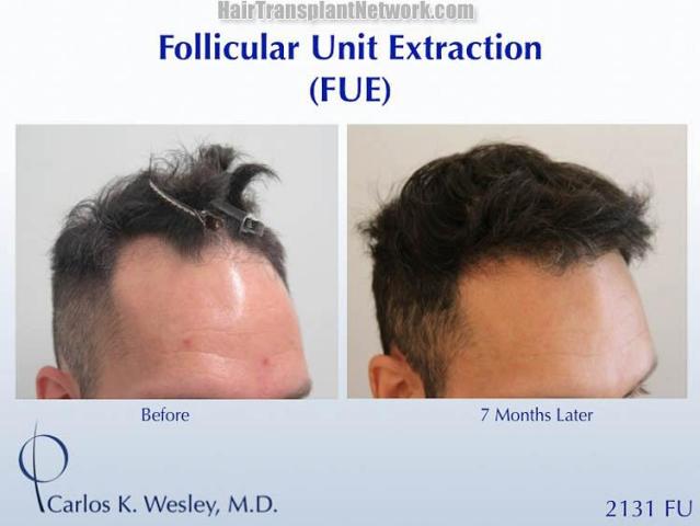 Hair restoration procedure before and after results