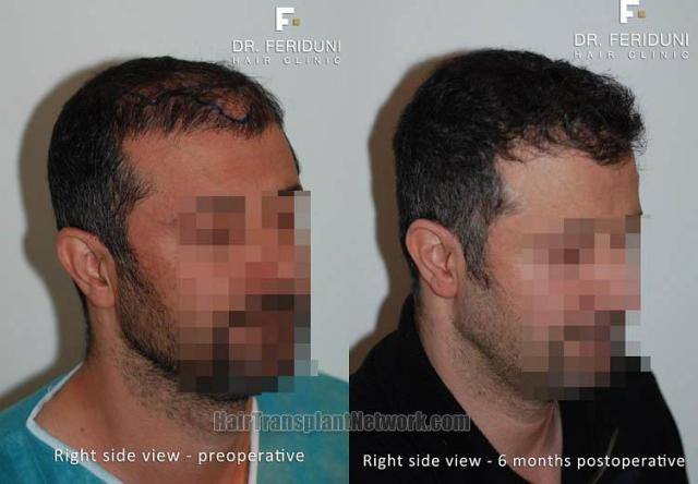 Hair transplantation surgery before and after images