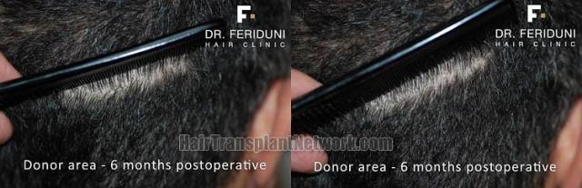 Hair restoration procedure before and after pictures