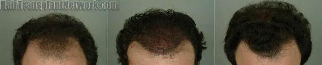 Tilt down view before and after hair restoration surgery