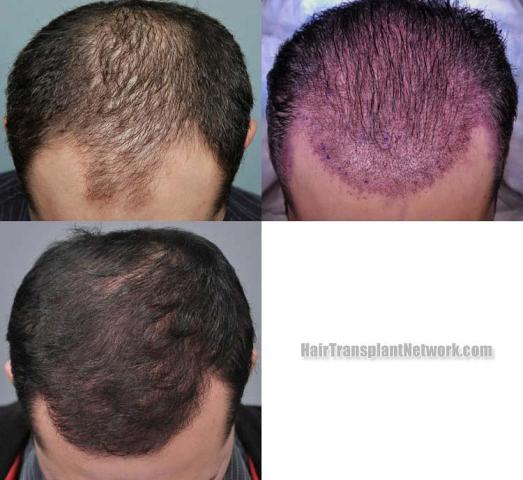 Top view before and after hair restoration results