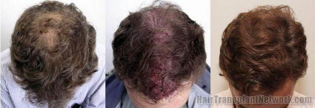 Hair transplant results viewing pictures from the top