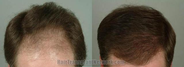 Top view before and after hair restoration photos