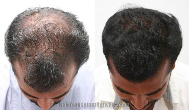 Top view - Before and after hair restoration procedure