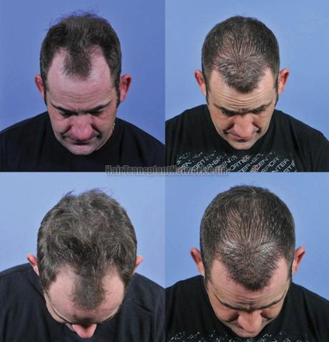 Hair restoration procedure before and after results