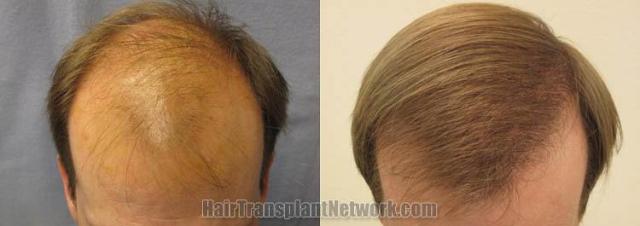 Top view before and after hair restoration results