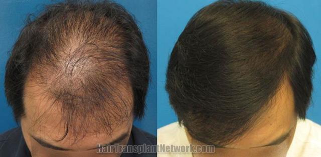 Top view before and after hair restoration results