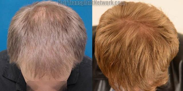 Hair transplantation surgery before and after photos