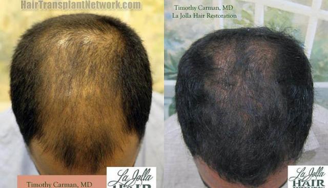 Hair transplantation surgery before and after photos