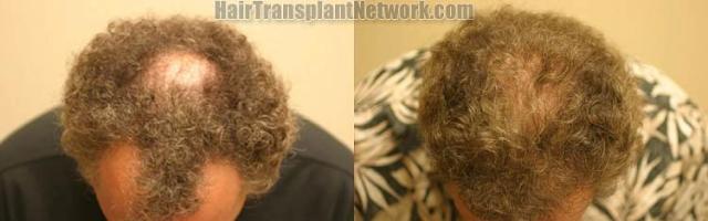 Top view before and after hair restoration results