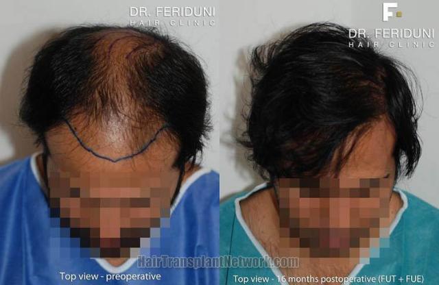 Hair restoration procedure before and after results