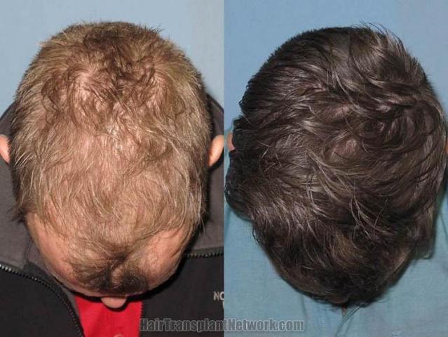 Hair transplantation surgery before and after pictures