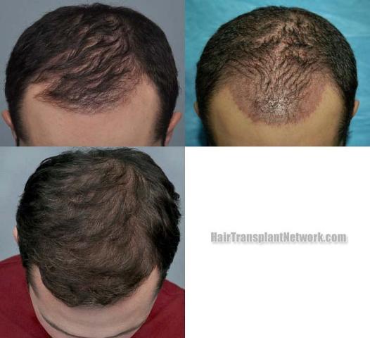 Hair transplantation surgery before and after images