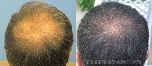 Photos of crown before and six months after hair restoration