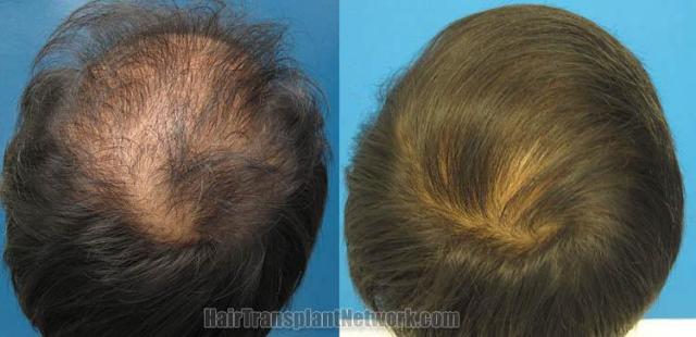 Hair transplantation surgery before and after images