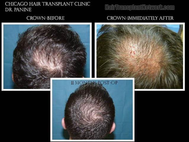 Back view before and after hair transplantation photos