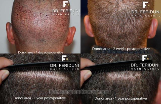 Hair transplantation surgery before and after images