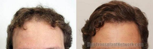 Front view photos- Before and after hair restoration