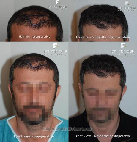 Hair restoration procedure before and after results