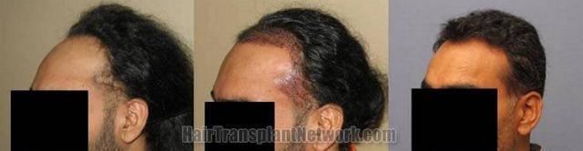 Hair restoration procedure results