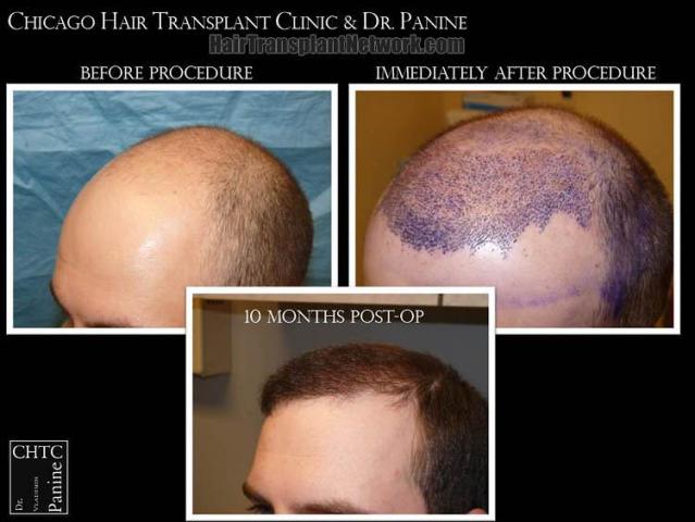 Hair transplantation surgery before and after images