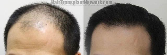 Hair transplantation surgery before and after pictures