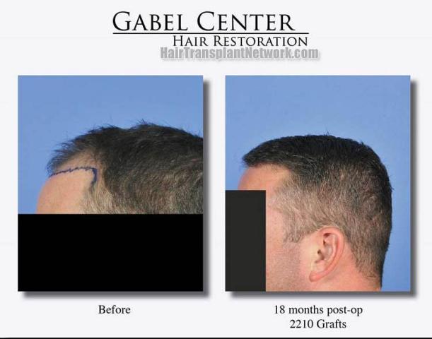 Hair transplantation surgery before and after images