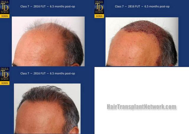 Hair transplantation surgery before and after images