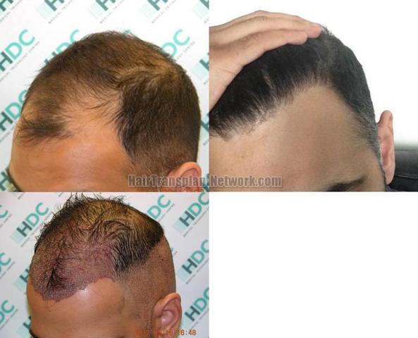 Hair restoration procedure before and after pictures