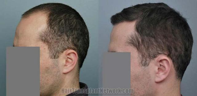 Hair restoration procedure before and after results