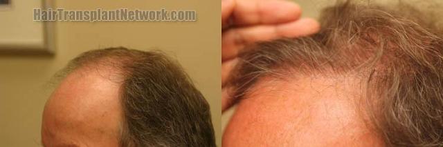 Hair transplantation surgery before and after pictures