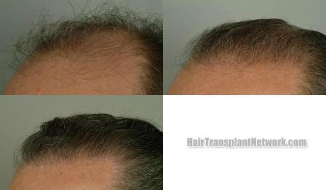 Hair transplantation surgery before and after pictures