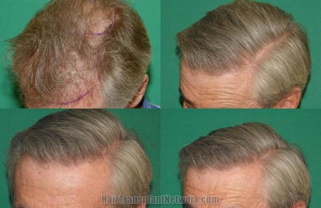 Hair transplantation surgery before and after images