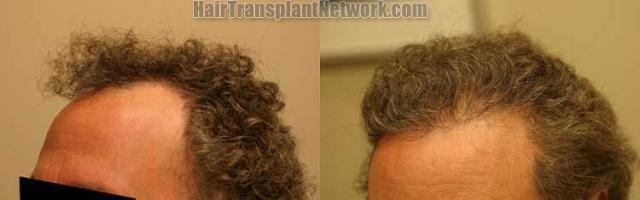 Hair transplantation surgery before and after photos